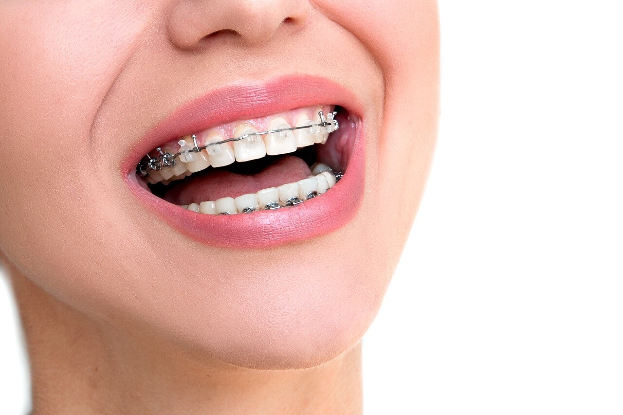 Fast Braces Can Help You Enjoy a Perfect Smile in Less Time