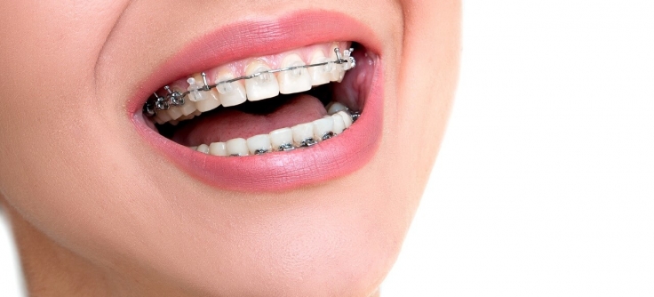 How Damon Braces Compare to Other Treatments - Euro Dental Care